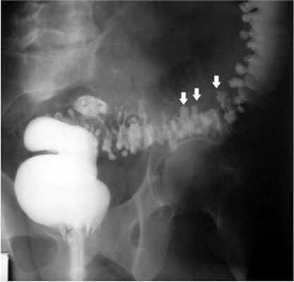 Дивертикулез лечение