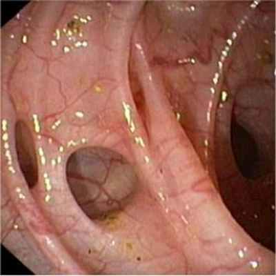 Дивертикулез лечение