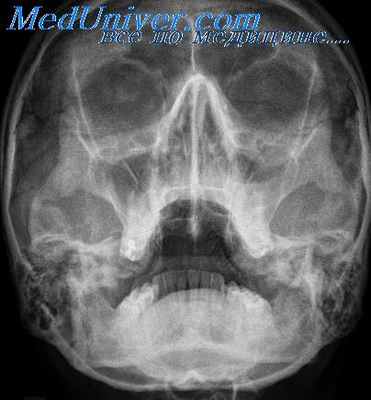 острый этмоидит