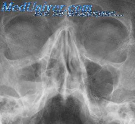 остый гайморит