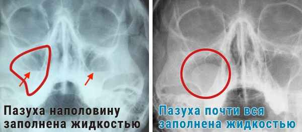 гайморит на снимке.jpg