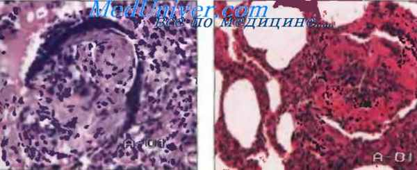 бронхиолит