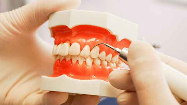 Язвенно-некротический стоматит Венсана