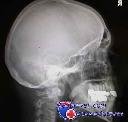 паротитный менингит