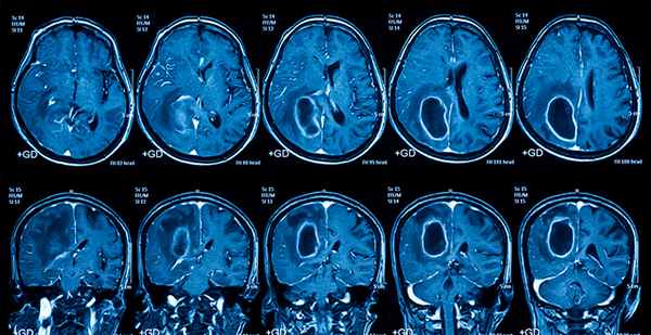Прогноз поперечного миелита