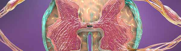 Поперечный миелит