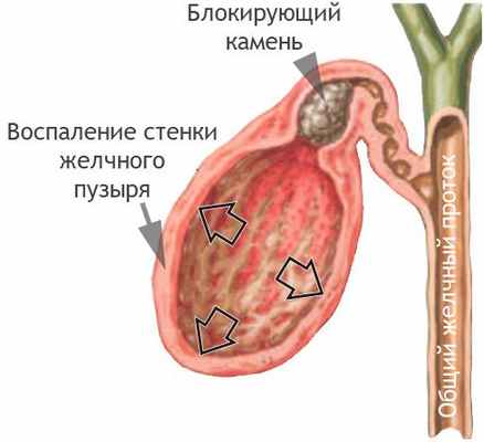 Острое воспаление желчного пузыря