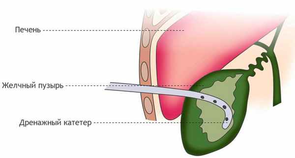 Схема дренирования желчного пузыря при остром холецистите