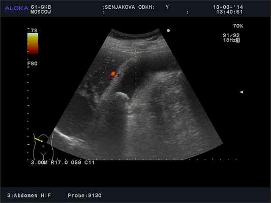Ультразвуковая картина острого холецистита
