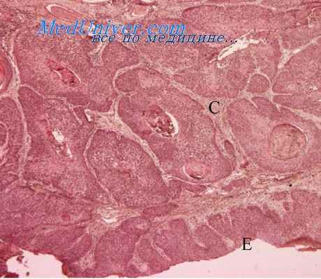 опухоль кожи