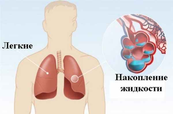 Что такое отек легких