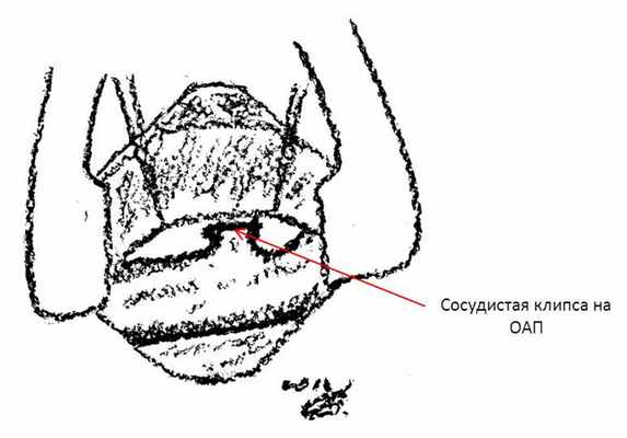 схема операции - клипирования ОАП