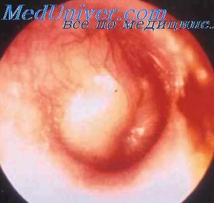 средний отит