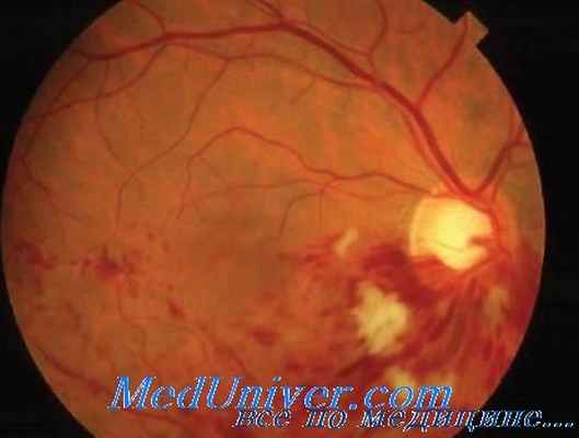 поражение глаза серебром