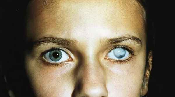 ожог роговицы симптомы