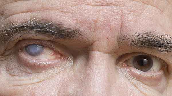 химический ожог роговицы глаза