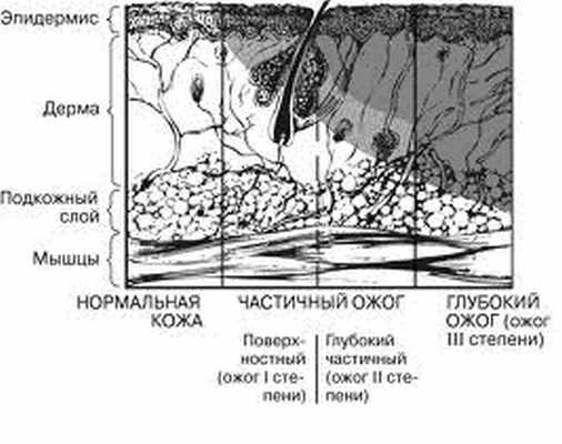 Лечение ожогов
