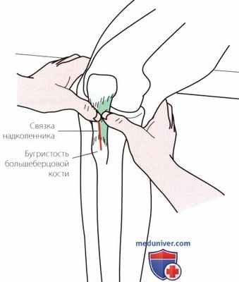 Пальпация коленного сустава спереди