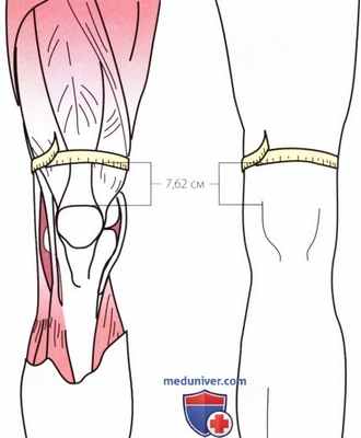 Пальпация коленного сустава спереди