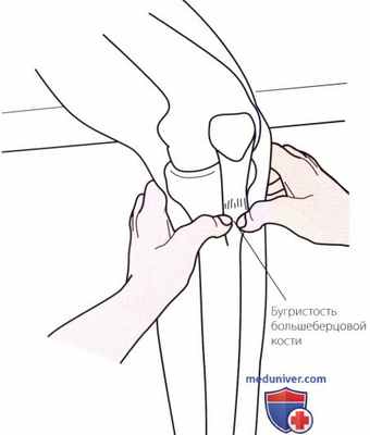 Пальпация коленного сустава спереди