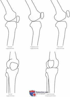 Пальпация коленного сустава спереди