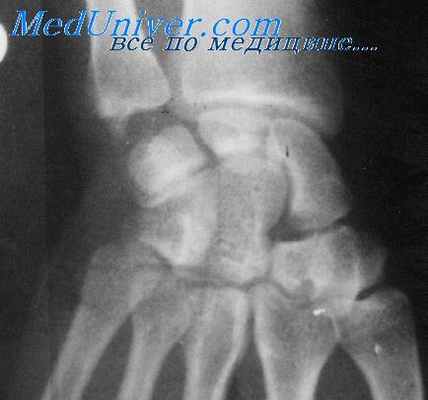 лучезапястный сустав