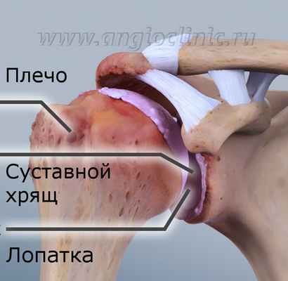 Артроз плечевого сустава