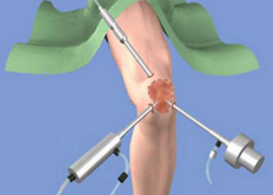 Разрыв медиальной внутренней коллатеральной связки