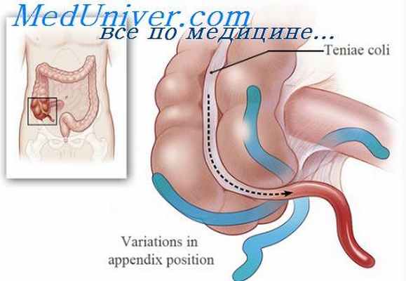 пальпация хронического аппендицита