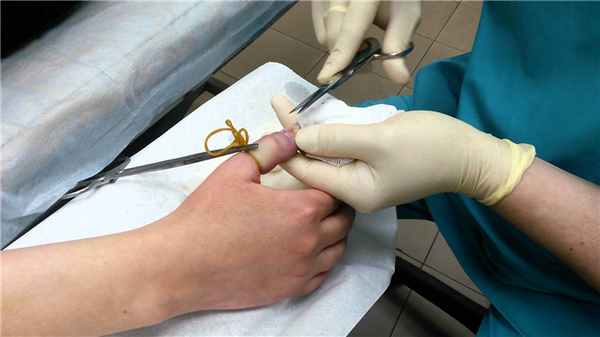 Лечение панариция 