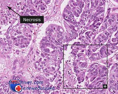 папиллома трахеи