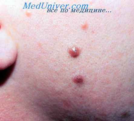 папилломатозный мягкий эпидермальный невус
