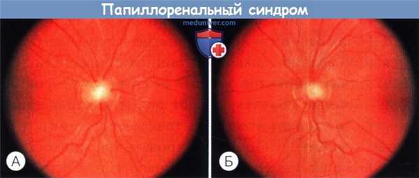 Папиллоренальный синдром