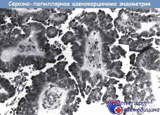 Серозно-папиллярная аденокарцинома эндометрия