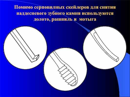 Помимо серповилных скейлеров для снятия наддесневого зубного камня используются долото, рашпиль и мотыга