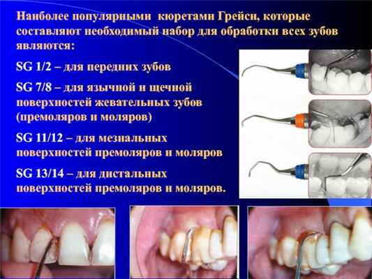 SG 1/2 – для передних зубовSG 7/8 – для язычной и щечной поверхностей жевательных зубов (премоляров и