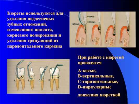 Кюреты используются для удаления поддесневых зубных отложений, измененного цемента, корневого полирования и удаления грануляций из пародонтального карманаПри