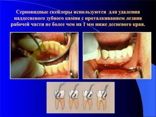 Серповидные скейлеры используются для удаления наддесневого зубного камня с проталкиванием лезвия рабочей части не более чем на