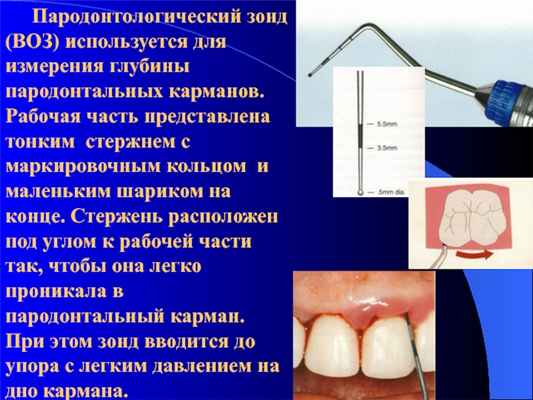 Пародонтологический зонд (ВОЗ) используется для измерения глубины пародонтальных карманов. Рабочая часть представлена тонким стержнем с маркировочным кольцом