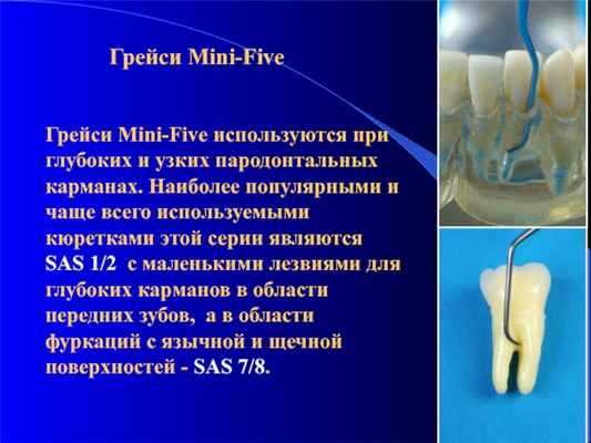 Грейси Mini-FiveГрейси Mini-Five используются при глубоких и узких пародонтальных карманах. Наиболее популярными и чаще всего используемыми кюретками