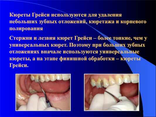 Кюреты Грейси используются для удаления небольших зубных отложений, кюретажа и корневого полированияСтержни и лезвия кюрет Грейси –