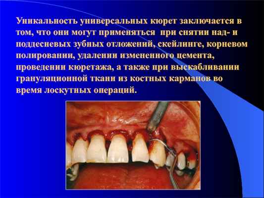 Уникальность универсальных кюрет заключается в том, что они могут применяться при снятии над- и поддесневых зубных отложений,