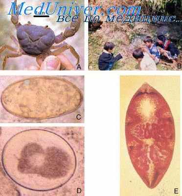 парагонимоз печени