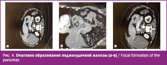 Очаговое образование поджелудочной железы
