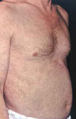 Рис. 1. Верхняя часть туловища больного хроническим каплевидным парапсориазом: на коже туловища и руки множественные полусферические красные папулы