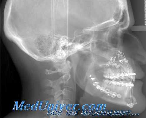 опухоли гипофиза на рентгенограмме