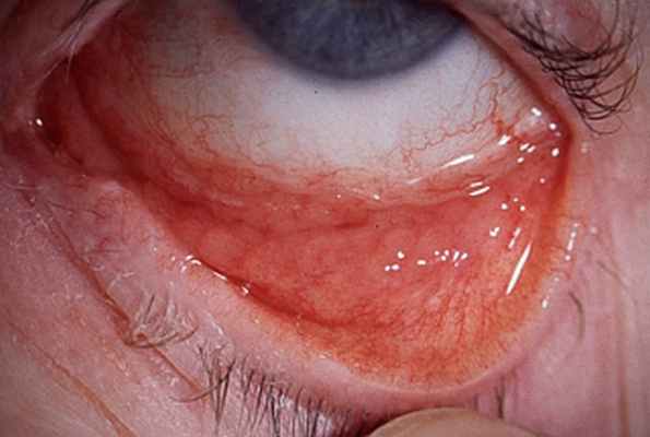 Острый бактериальный конъюнктивит