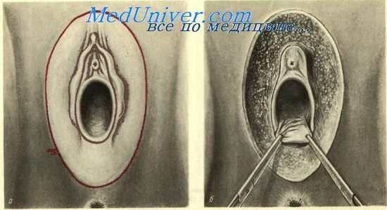 вульвэктомия