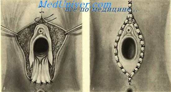 вульвэктомия