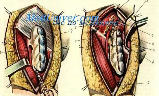 вульвэктомия